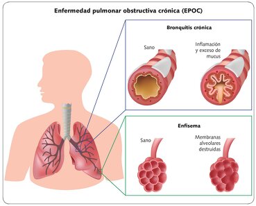 Bronquitis Crónica vs Enfisema Pulmonar
